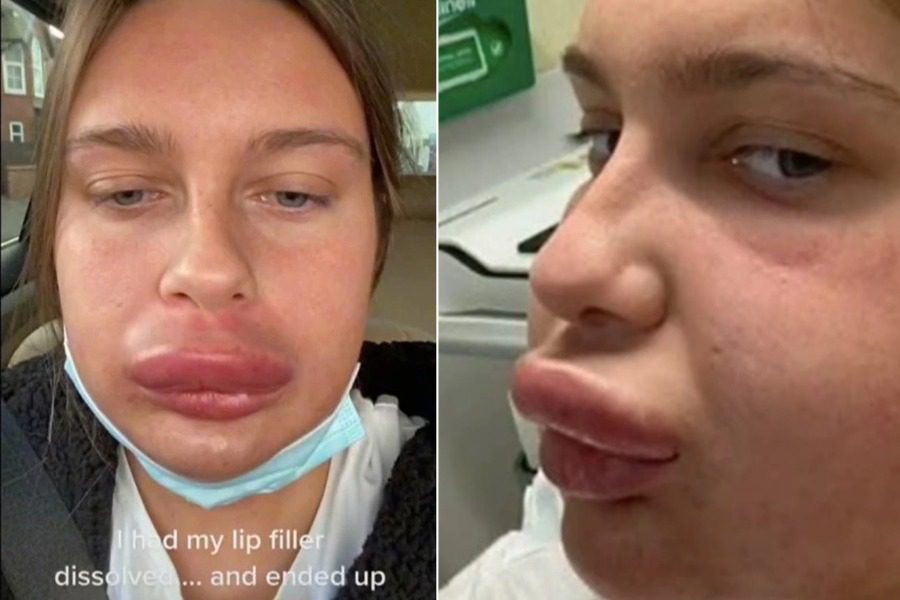 Έπαθε αλλεργική αντίδραση μετά τα fillers χειλιών και έγινε viral στο TikTok
