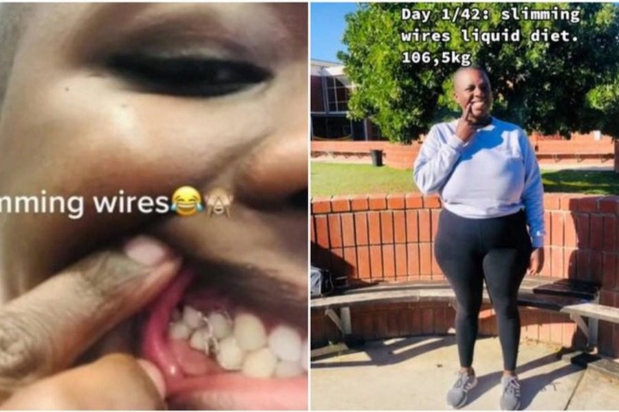 Γυναίκα έδεσε τα δόντια της με σύρμα για να μην τρώει