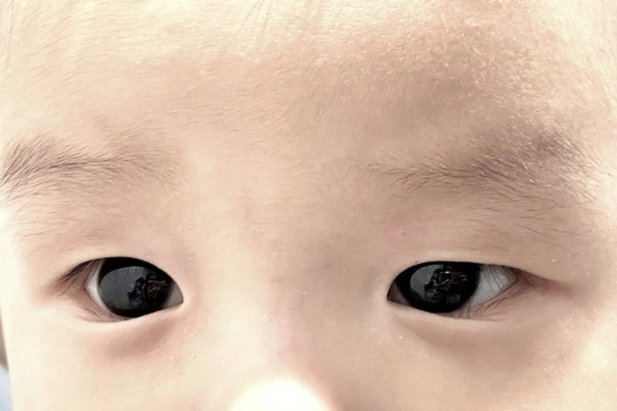 Ταϊλάνδη: Φάρμακο κατά του κορωνoϊού «άλλαξε προσωρινά» το χρώμα των ματιών ενός μωρού