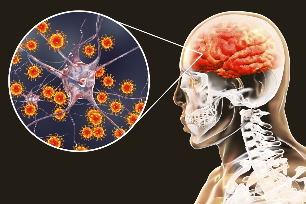 Μηνιγγίτιδα: Συναγερμός στην Πάτρα