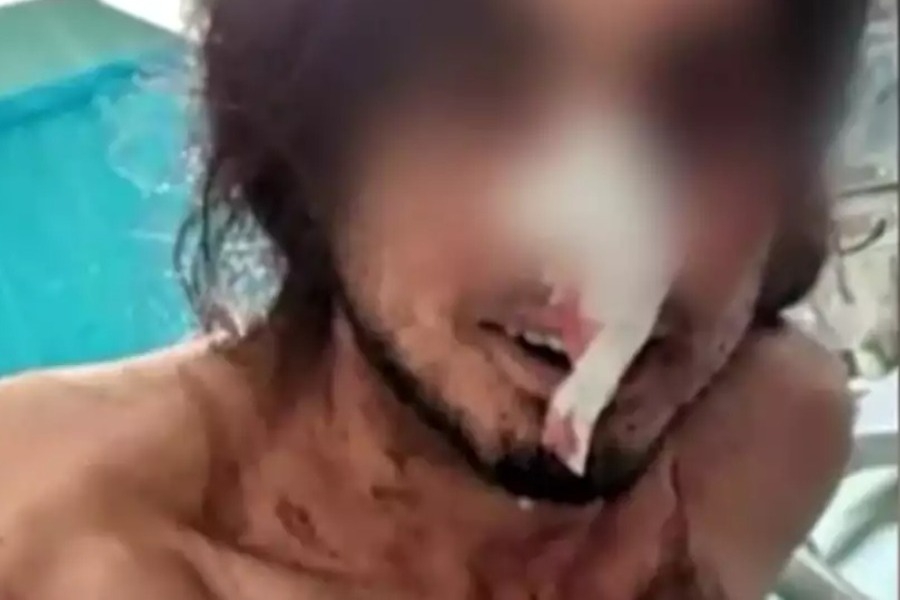 Πάρνηθα: «Δέχτηκα πέντε μαχαιριές, έχασα πολύ αίμα» λέει θύμα της πρωτοφανούς επίθεσης