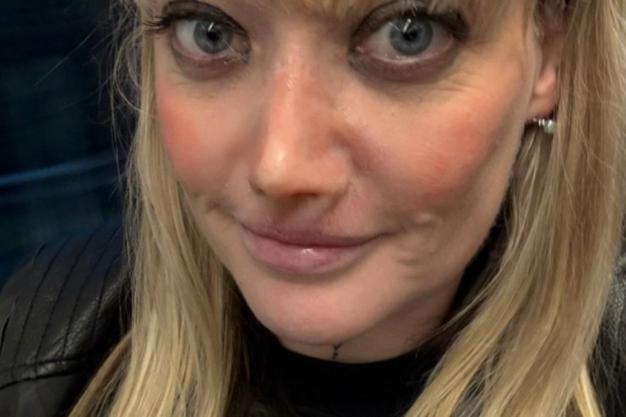 Σε απόγνωση Βρετανίδα που πήγε για νέα δόντια στην Τουρκία και κατέληξε χωρίς μύτη