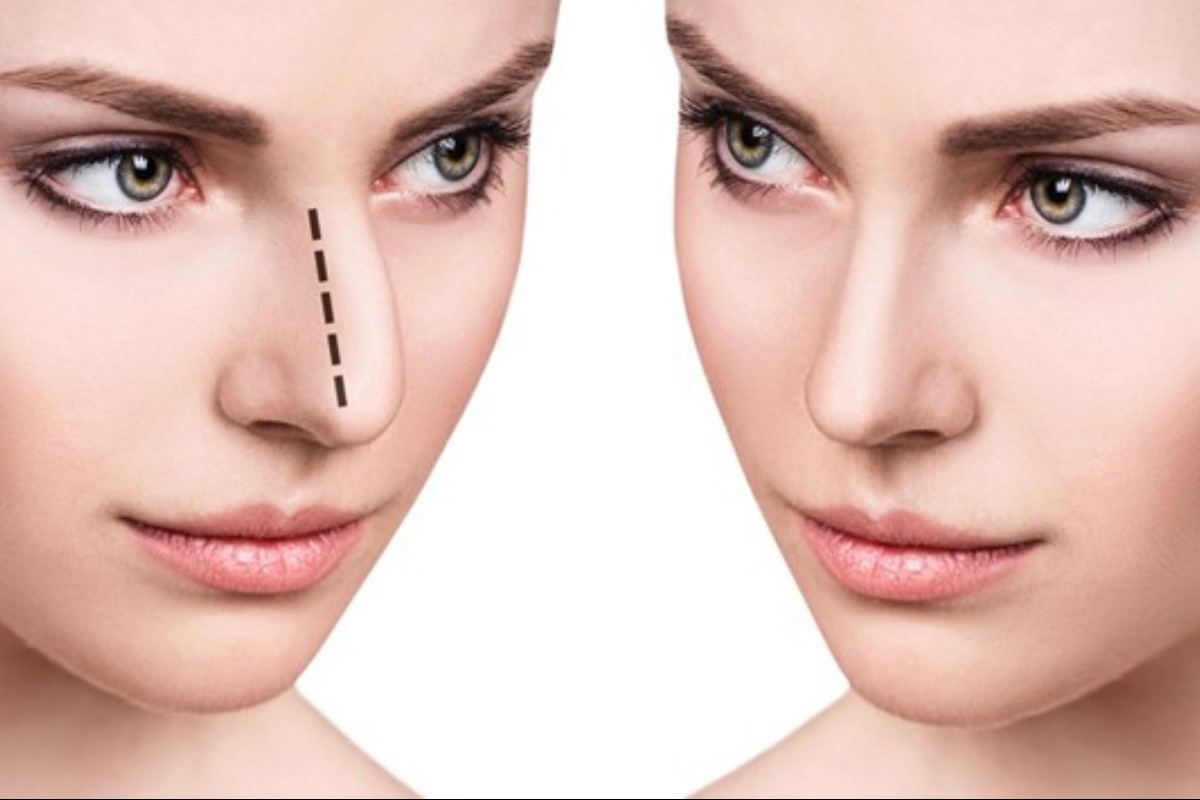 Διάφραγμα μύτης με σκολίωση; Πώς η επέμβαση για στραβό διάφραγμα μπορεί να βελτιώσει την εικόνα αλλά και την υγεία