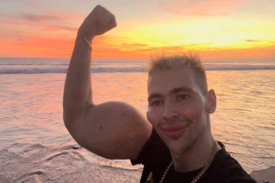 Κινδυνεύει να χάσει τα χέρια του ο «Ρώσος Ποπάι»: Έπαθε σοβαρή μόλυνση από τις ενέσεις για να μεγαλώσουν τα μπράτσα