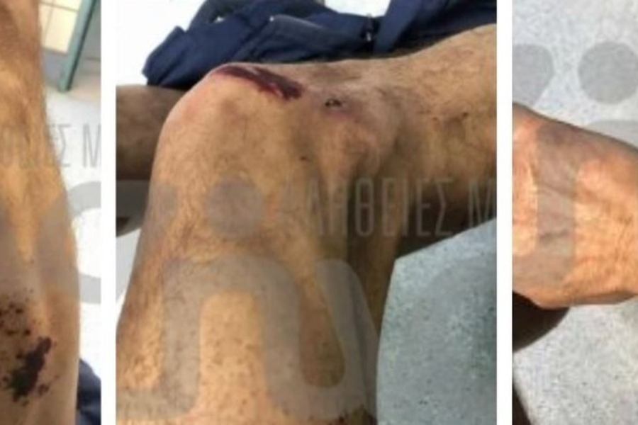 Τέμπη: Φωτογραφίες από τα χημικά εγκαύματα πυροσβεστών - «Έβγαλα το γάντι και είδα το χέρι άσπρο, είχε νεκρώσει ο ιστός»