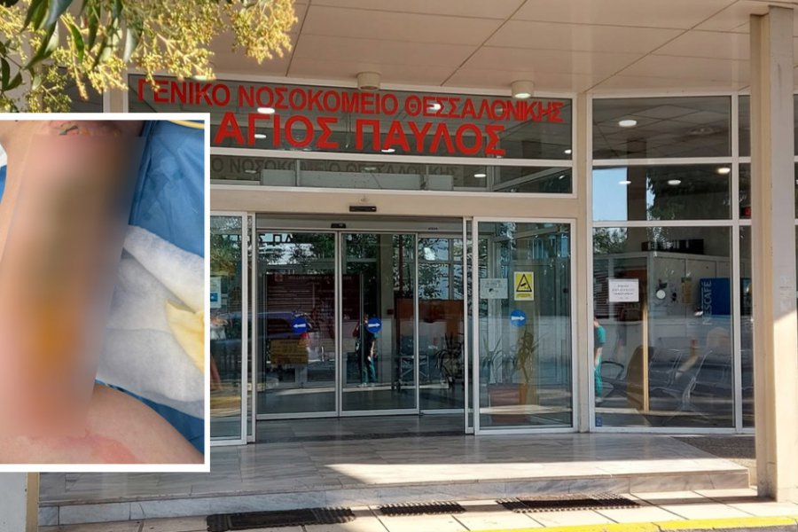 Εφιάλτης για 20χρονη στη Θεσσαλονίκη: Μπήκε στο νοσοκομείο για αφαίρεση κύστης κόκκυγα και κατέληξε με εγκαύματα τρίτου βαθμού - Τι λέει η ίδια για την περιπέτειά της στο νοσοκομείο Αγιος Παύλος - Η ζημιά που υπέστη η νεαρή γυμνάστρια, είναι τόσο σοβαρή που από τις αρχές Μαΐου έ