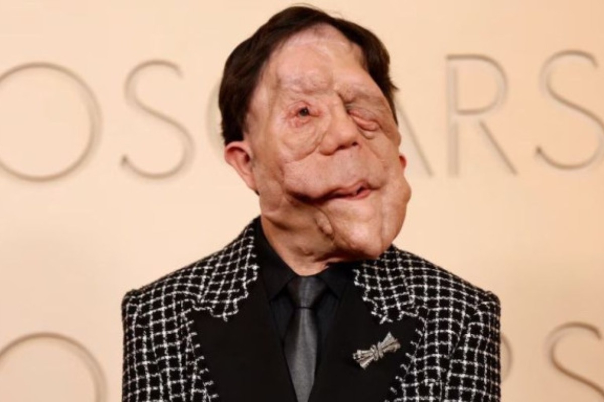 Ανταμ Πέρσον: Συγκλόνισε στο κόκκινο χαλί των Όσκαρ ‑ Η μάχη του με την νευροϊνωμάτωση