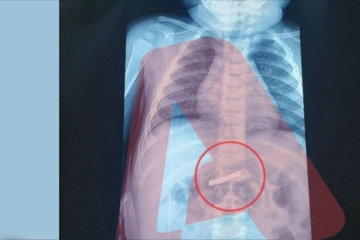 Αγωνία για αγοράκι τριών ετών - Κατάπιε ξυραφάκι