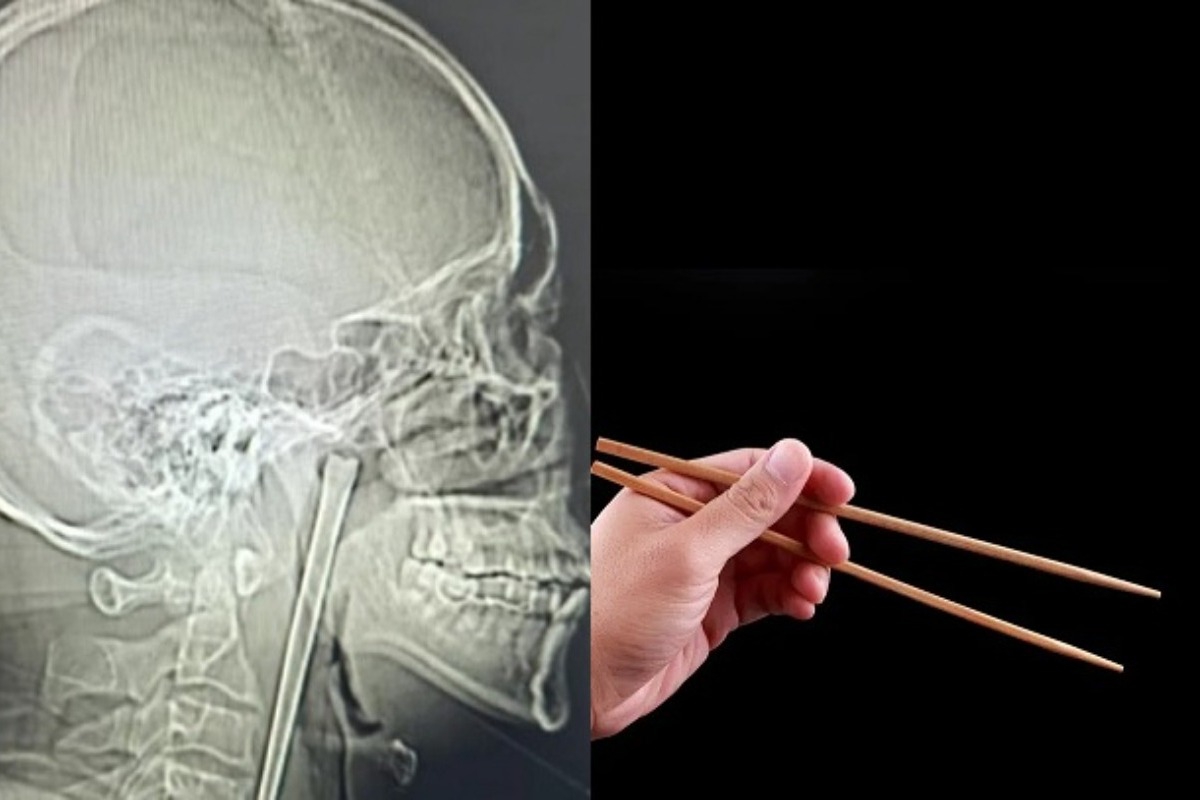 Το πιο παράξενο ιατρικό περιστατικό: Πώς ένας άντρας έζησε 8 χρόνια με ένα μεταλλικό chopstick σφηνωμένο στον λαιμό του