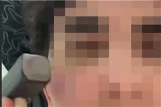 «Bonesmashing»: Η ανατριχιαστική τάση στη Ρωσία - Νέοι χτυπούν τα πρόσωπά τους με σφυριά