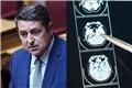 Ανεύρυσμα εγκεφάλου: Τι είναι αυτό που έπαθε ο Γιώργος Μυλωνάκης