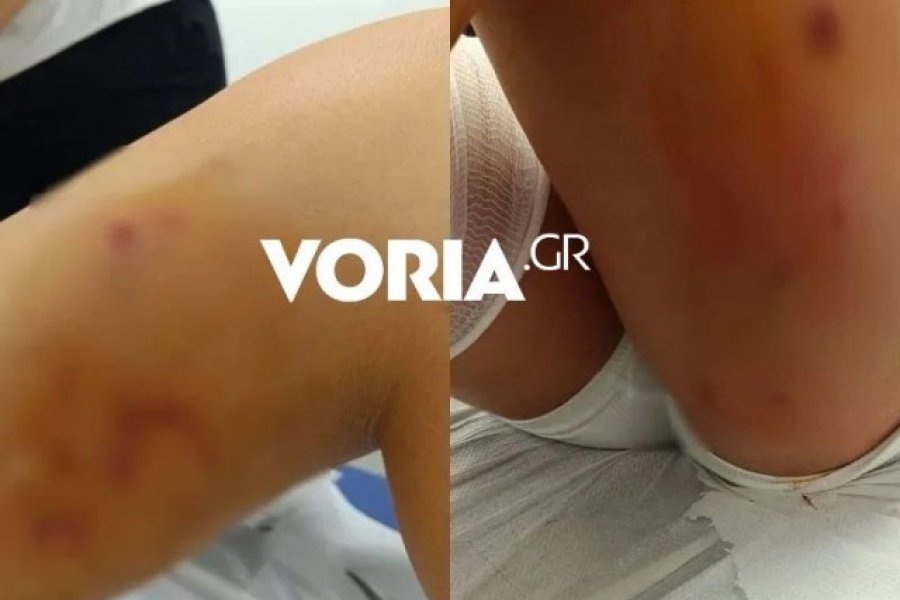 Θεσσαλονίκη: Στιγμές τρόμου για 12χρονη που δέχθηκε επίθεση από αγέλη σκυλιών - Το κορίτσι μεταφέρθηκε στο Κέντρο Υγείας Λαγκαδά όπου οι γιατροί περιποιήθηκαν τα τραύματά της