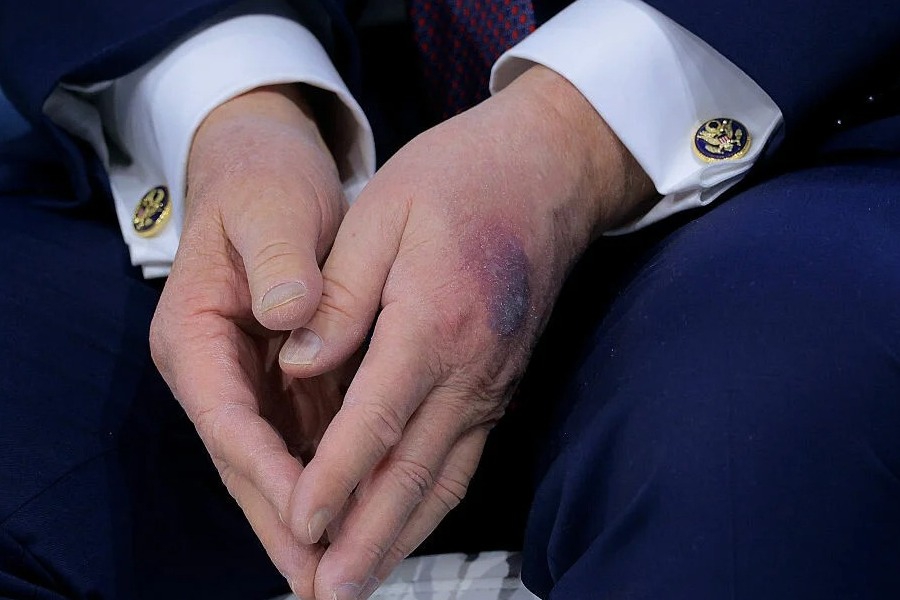 Με μώλωπα ξανά ο Τραμπ: Η εξήγηση που έδωσε για το σημάδι στο αριστερό χέρι - Ο Αμερικανός πρόεδρος έχει από καιρό μώλωπες στο δεξί του χέρι, οι οποίοι, σύμφωνα με το CNN, υπήρχαν πριν από την επιστροφή του στον Λευκό Οίκο